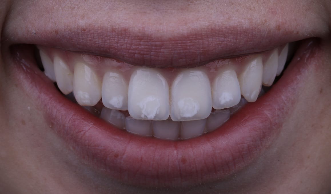 Porcelain Veneers San Luis Obispo Porcelain Veneers in Arroyo Grande