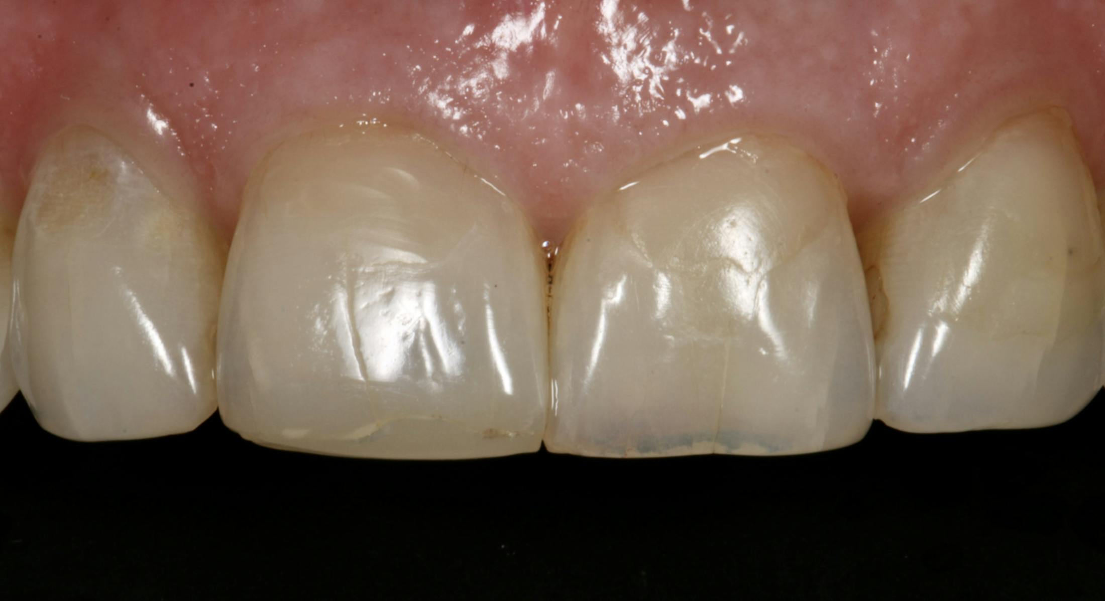 Veneers Before & After Photos Islay Hill Dentistry Co.