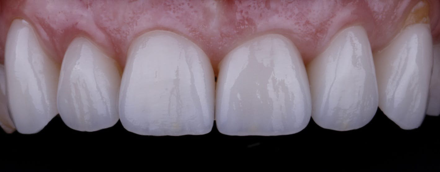 Veneers Before & After Photos Islay Hill Dentistry Co.