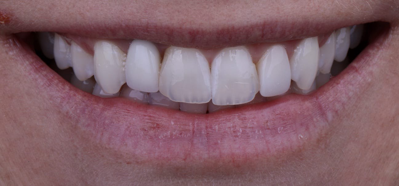 Veneers Before & After Photos Islay Hill Dentistry Co.
