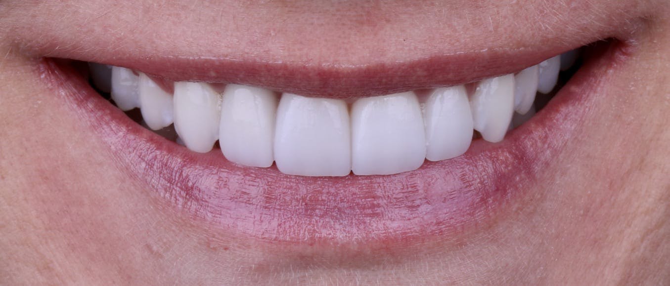 Veneers Before & After Photos Islay Hill Dentistry Co.