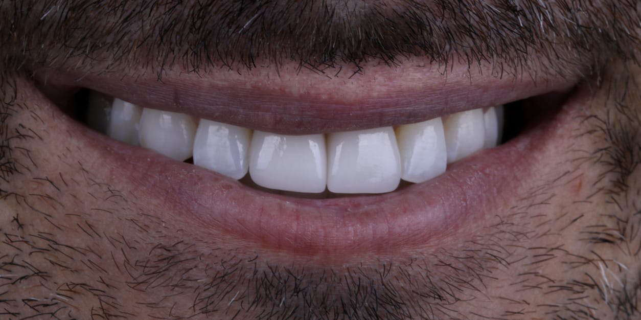 Veneers Before & After Photos Islay Hill Dentistry Co.