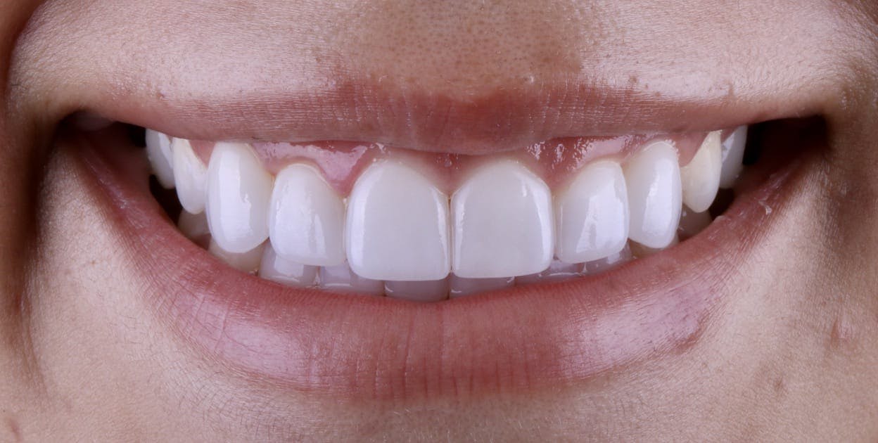 Veneers Before & After Photos Islay Hill Dentistry Co.