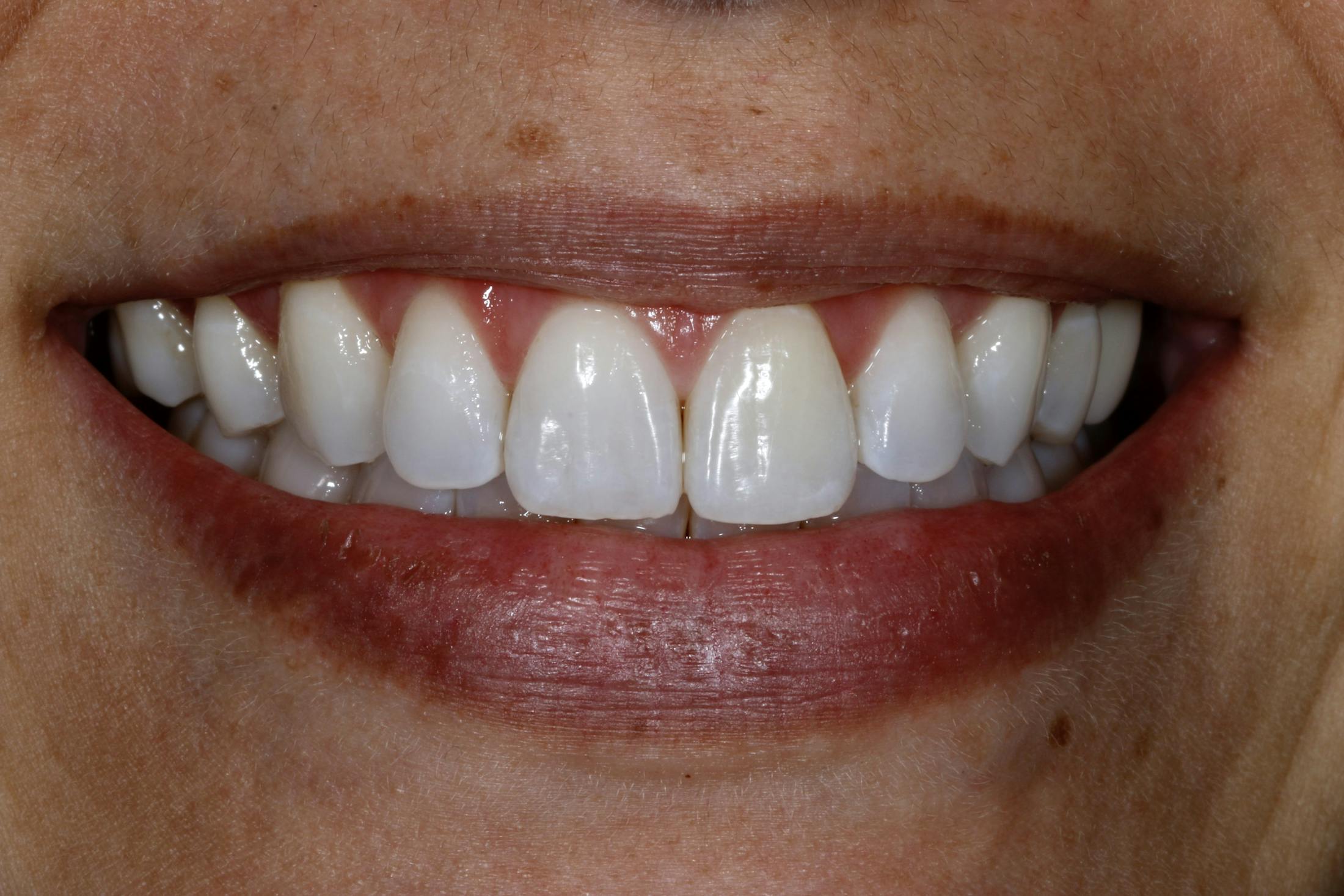 Veneers Before & After Photos Islay Hill Dentistry Co.