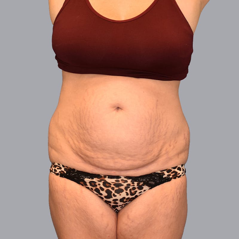Abdominoplasty Before & After Gallery - Patient 48704248 - Image 1
