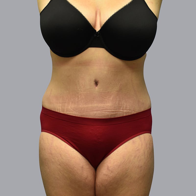 Abdominoplasty Before & After Gallery - Patient 48704248 - Image 2