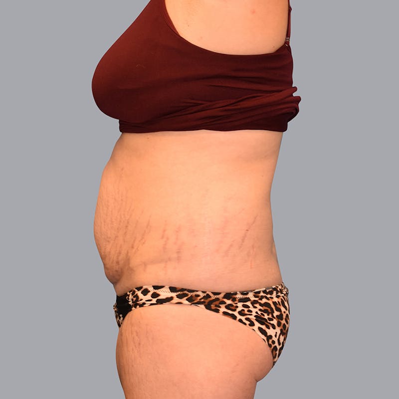 Abdominoplasty Before & After Gallery - Patient 48704248 - Image 3