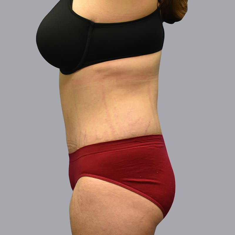 Abdominoplasty Before & After Gallery - Patient 48704248 - Image 4
