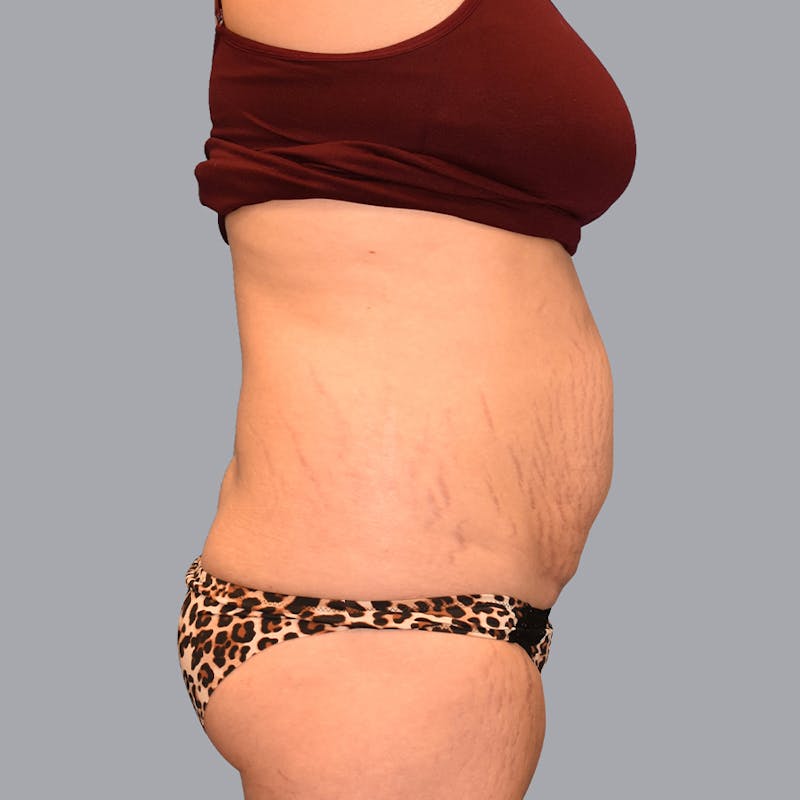 Abdominoplasty Before & After Gallery - Patient 48704248 - Image 5