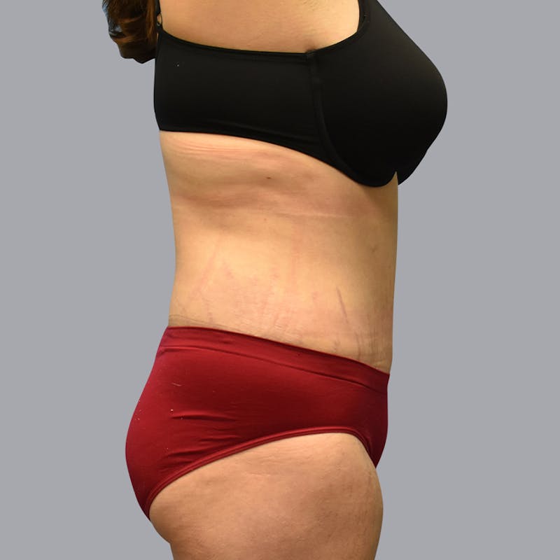 Abdominoplasty Before & After Gallery - Patient 48704248 - Image 6