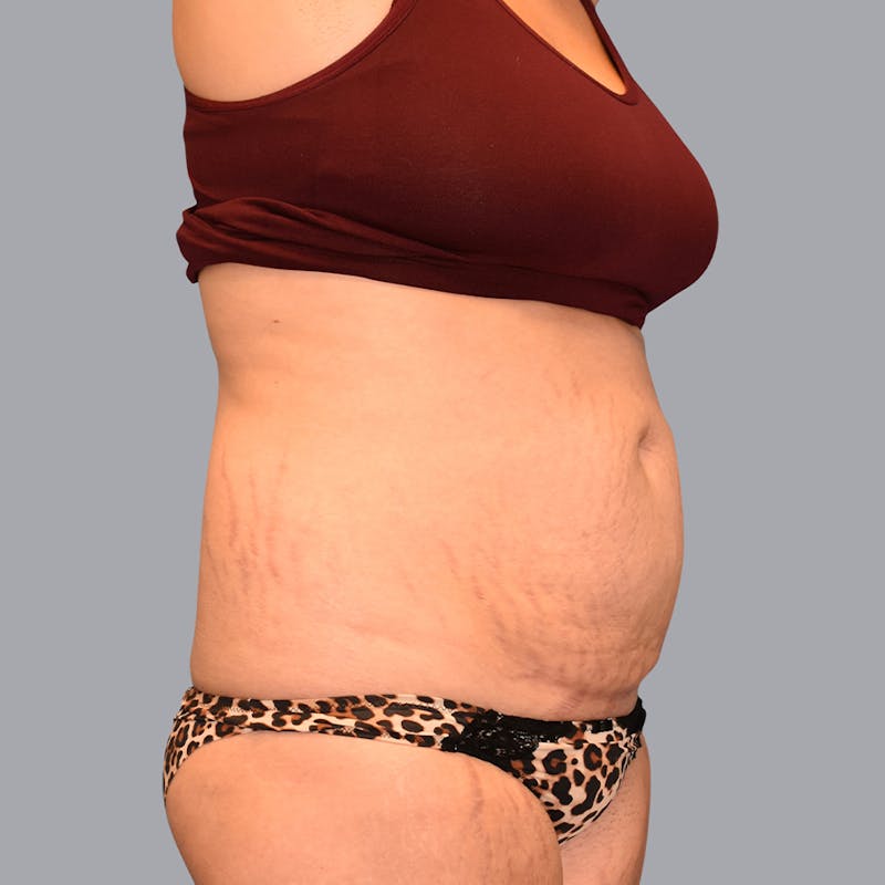 Abdominoplasty Before & After Gallery - Patient 48704248 - Image 7