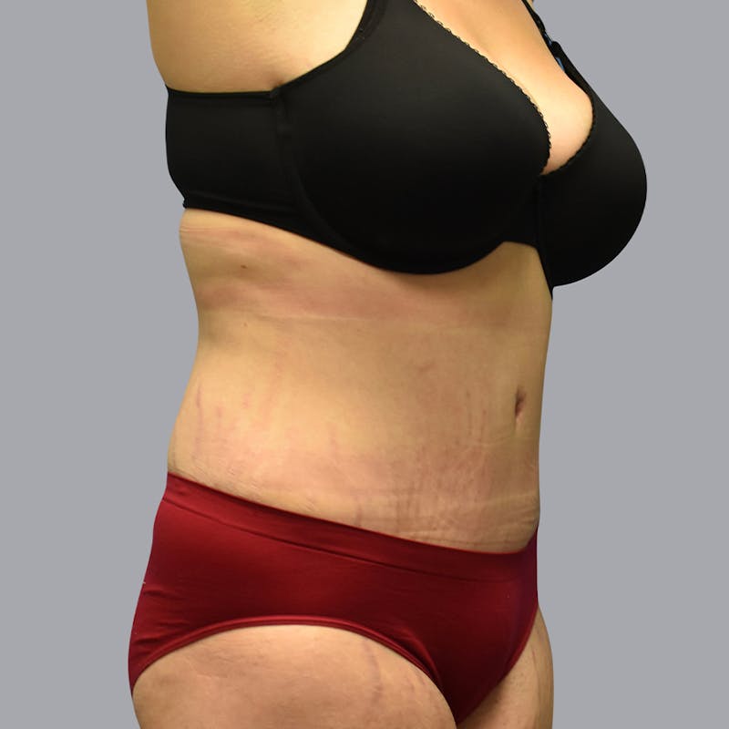 Abdominoplasty Before & After Gallery - Patient 48704248 - Image 8