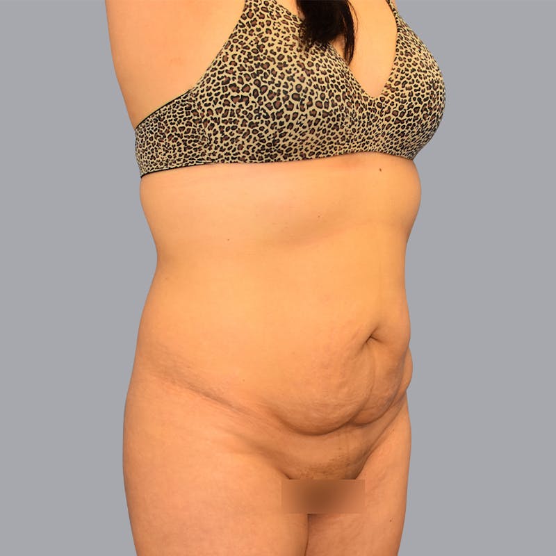 Abdominoplasty Before & After Gallery - Patient 48697825 - Image 1