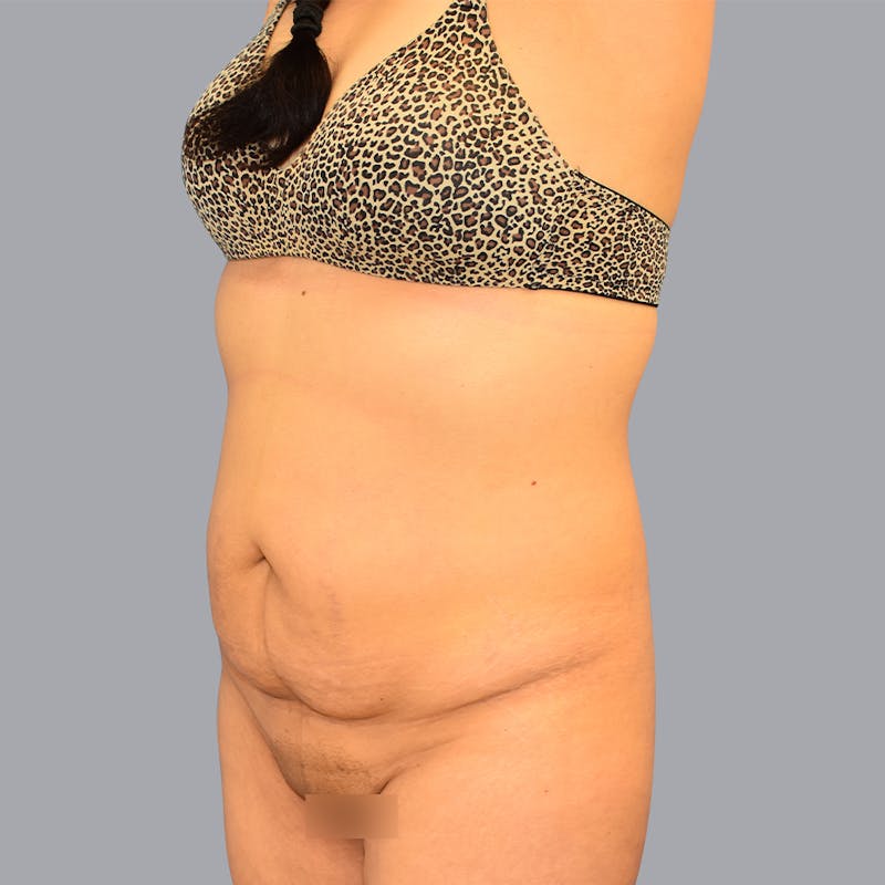 Abdominoplasty Before & After Gallery - Patient 48697825 - Image 3