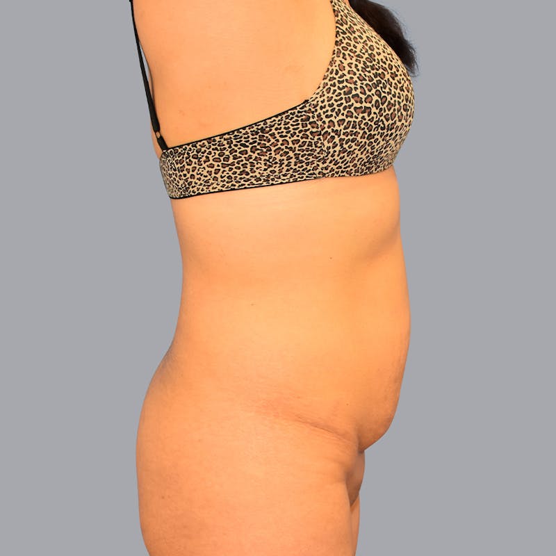 Abdominoplasty Before & After Gallery - Patient 48697825 - Image 5