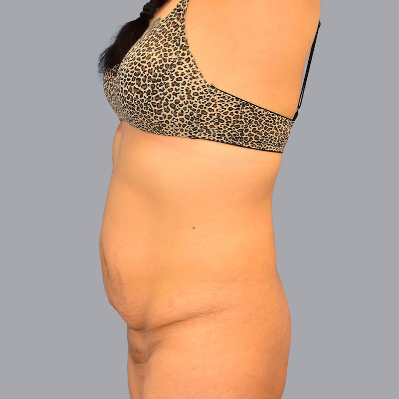 Abdominoplasty Before & After Gallery - Patient 48697825 - Image 7