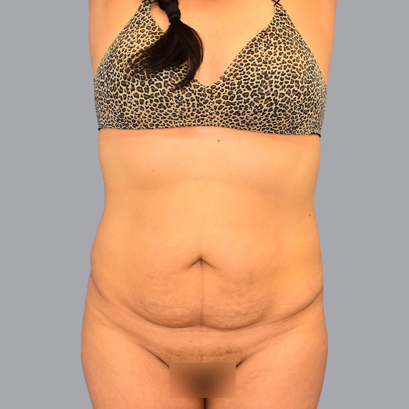 Abdominoplasty Before & After Gallery - Patient 48697825 - Image 9