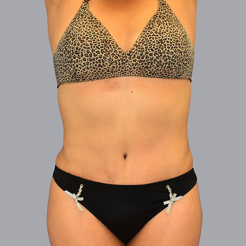 Abdominoplasty Before & After Gallery - Patient 48697825 - Image 10