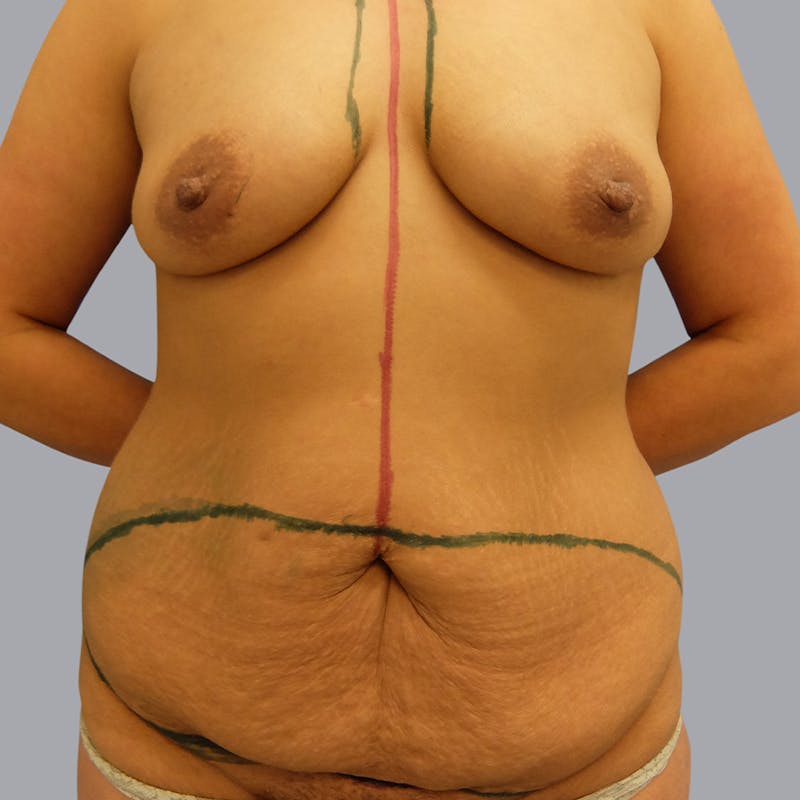Mommy Makeover Before & After Gallery - Patient 48697861 - Image 1