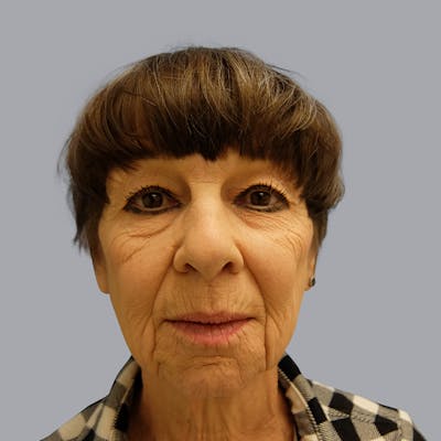 Facelift and Neck Lift Before & After Gallery - Patient 106440283 - Image 1