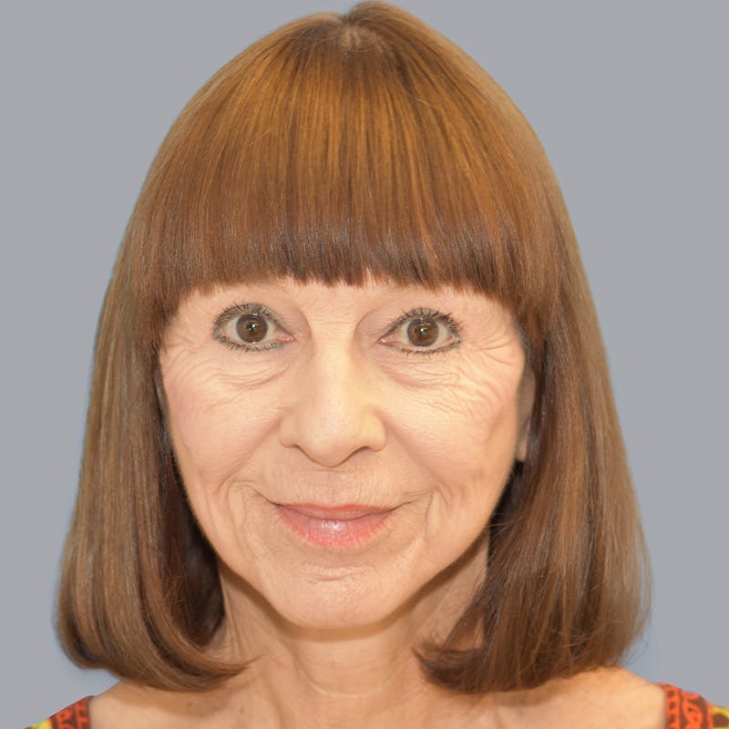 Facelift and Neck Lift Before & After Gallery - Patient 106440283 - Image 2