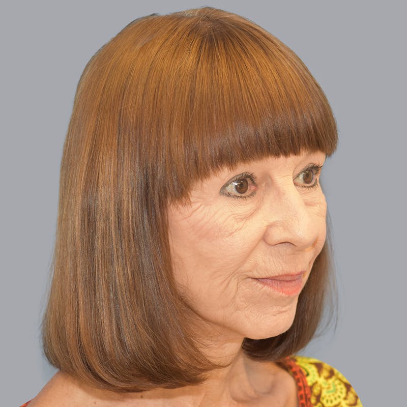 Facelift Before & After Gallery - Patient 48705557 - Image 4