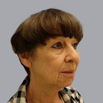 Facelift and Neck Lift Before & After Gallery - Patient 106440283 - Image 3