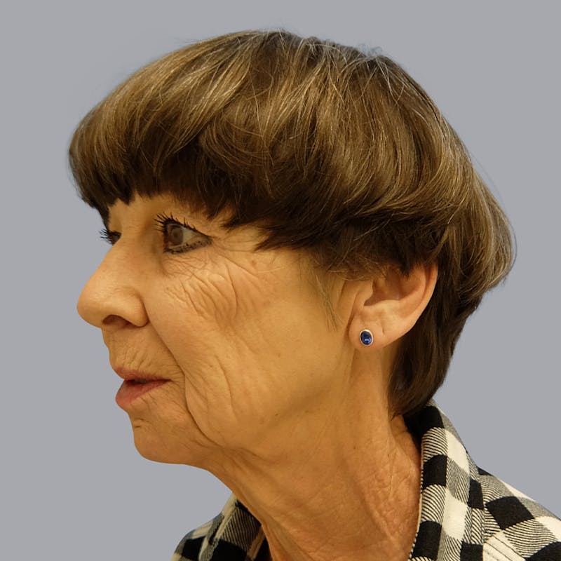 Facelift and Neck Lift Before & After Gallery - Patient 106440283 - Image 5