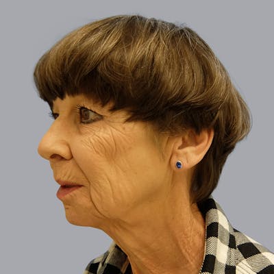Facelift and Neck Lift Before & After Gallery - Patient 106440283 - Image 5