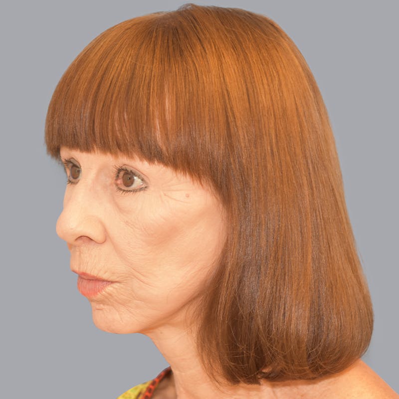Facelift Before & After Gallery - Patient 48705557 - Image 6