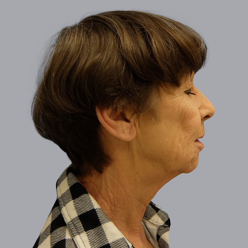Facelift and Neck Lift Before & After Gallery - Patient 106440283 - Image 7