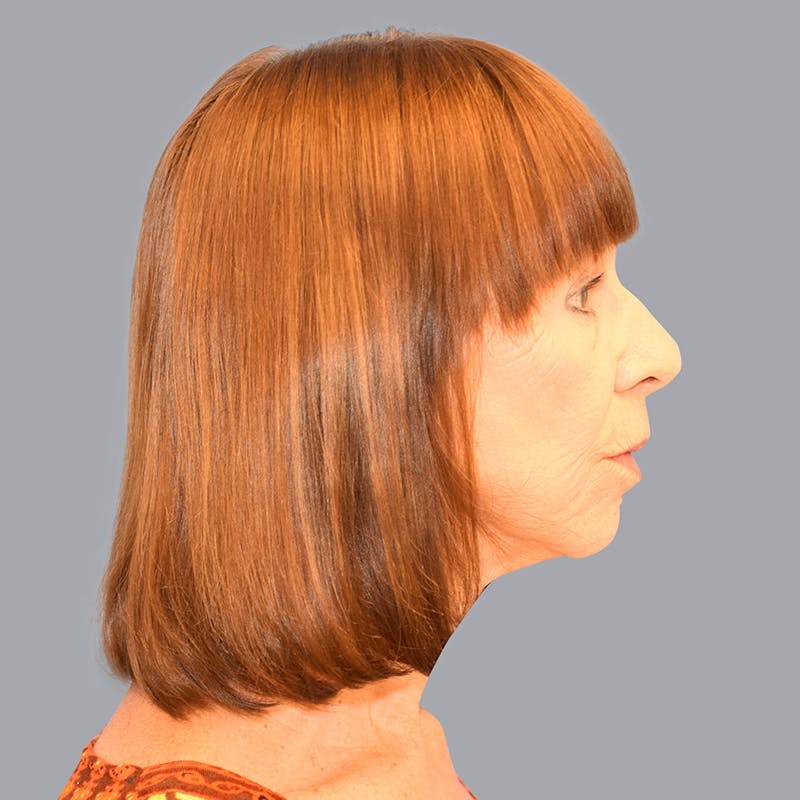 Facelift Before & After Gallery - Patient 48705557 - Image 8