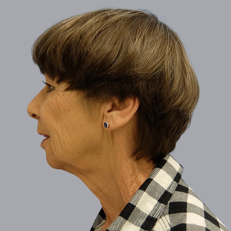 Facelift and Neck Lift Before & After Gallery - Patient 106440283 - Image 9