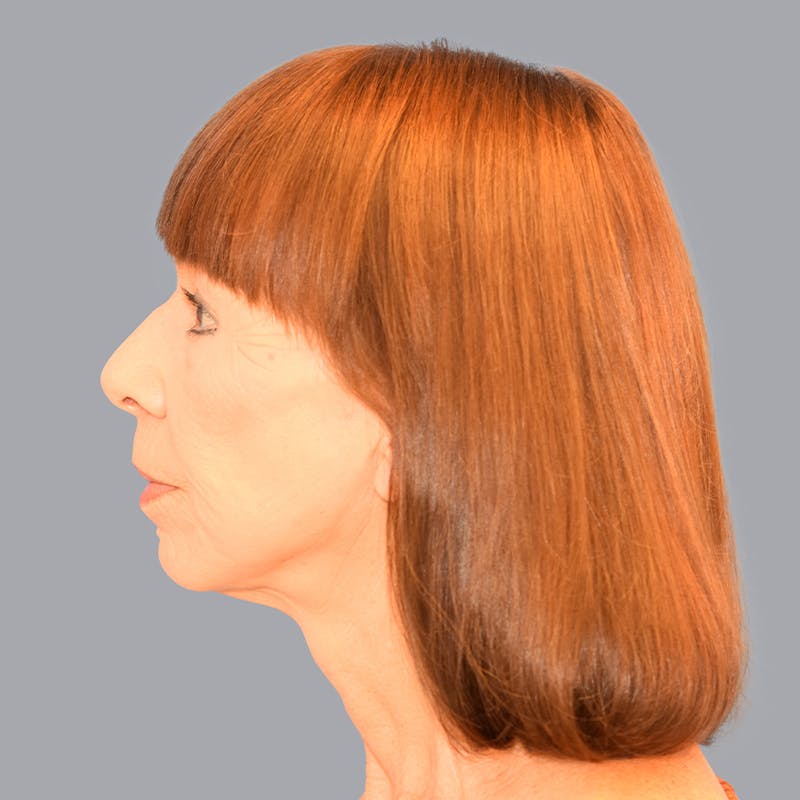 Facelift and Neck Lift Before & After Gallery - Patient 106440283 - Image 10