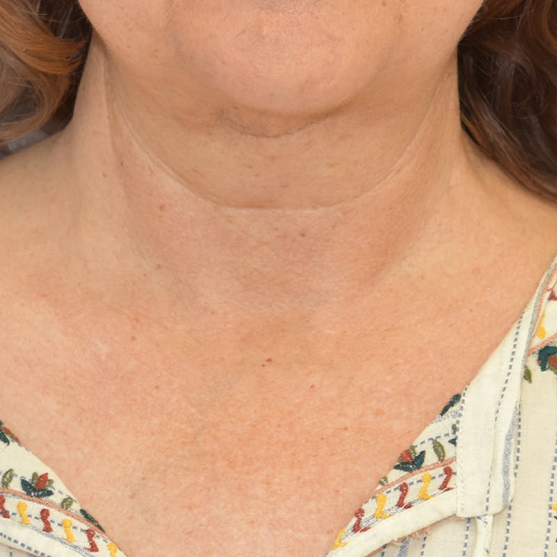 Facelift and Neck Lift Before & After Gallery - Patient 55333037 - Image 2
