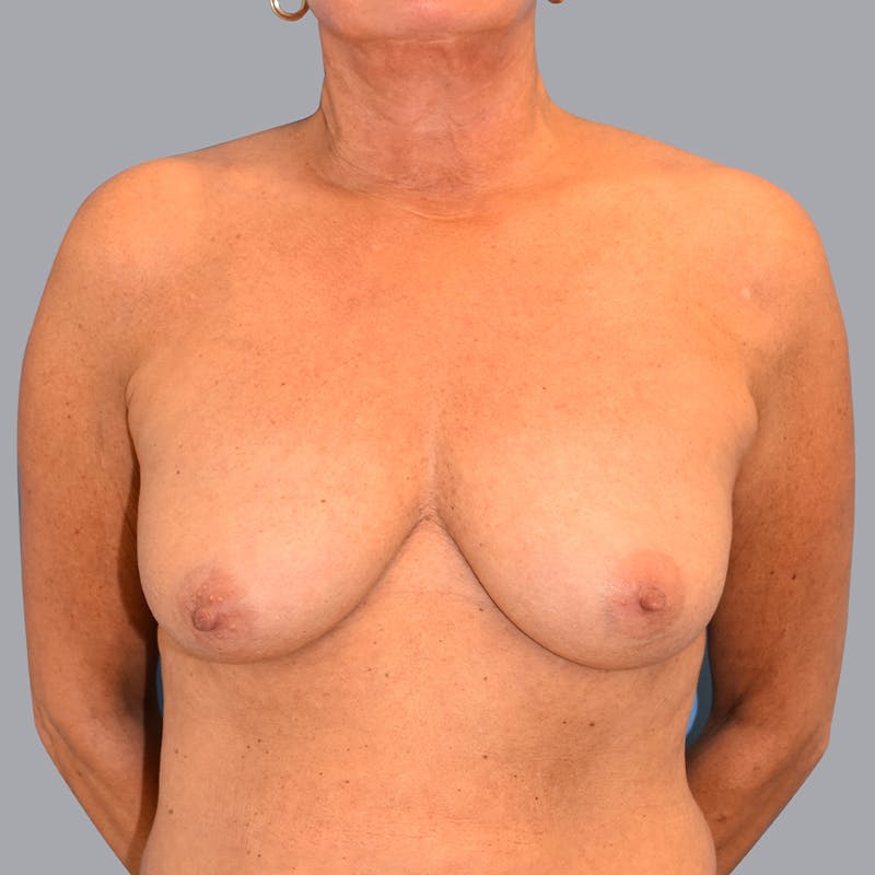 Breast Lift Before & After Gallery - Patient 48697874 - Image 1