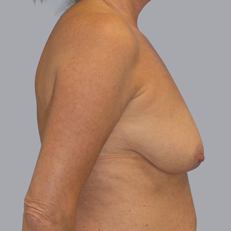 Breast Lift Before & After Gallery - Patient 48697874 - Image 3