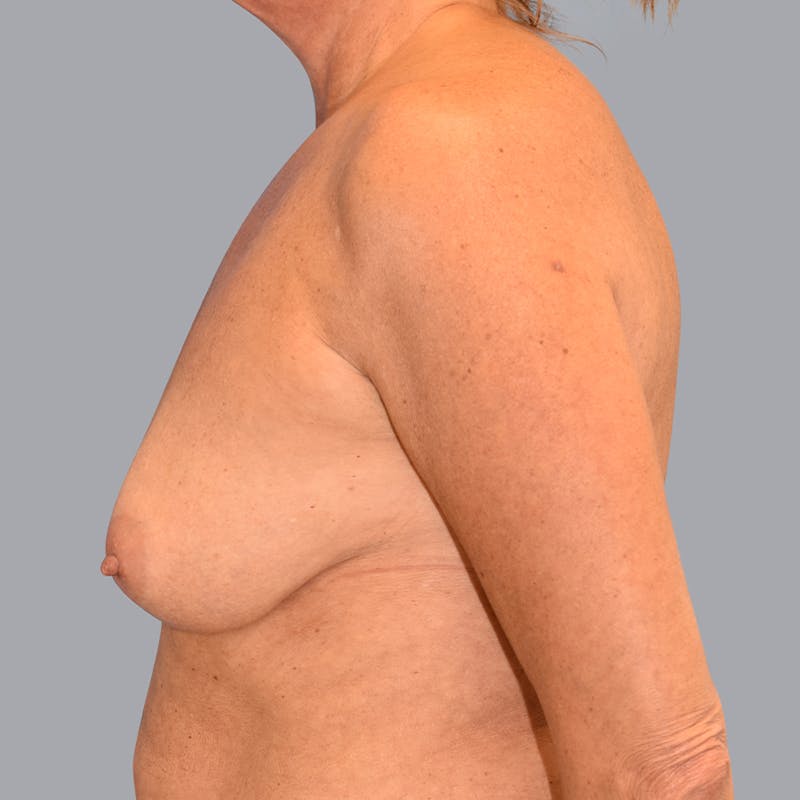 Breast Lift Before & After Gallery - Patient 48697874 - Image 5