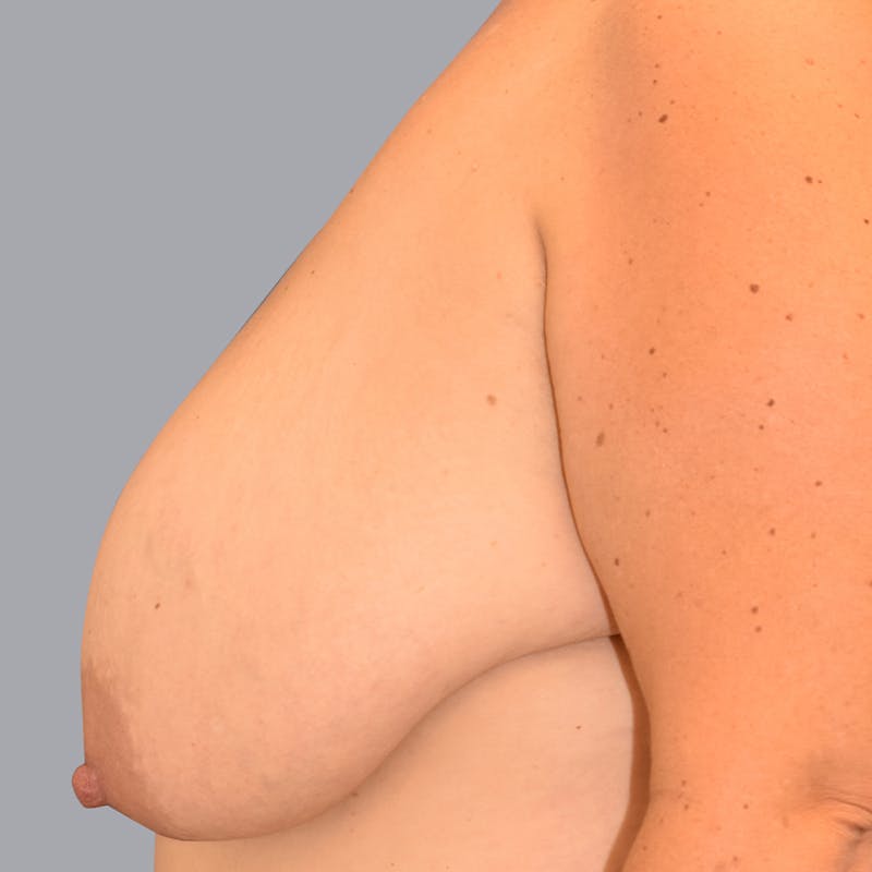 Breast Reduction Before & After Gallery - Patient 55333069 - Image 3
