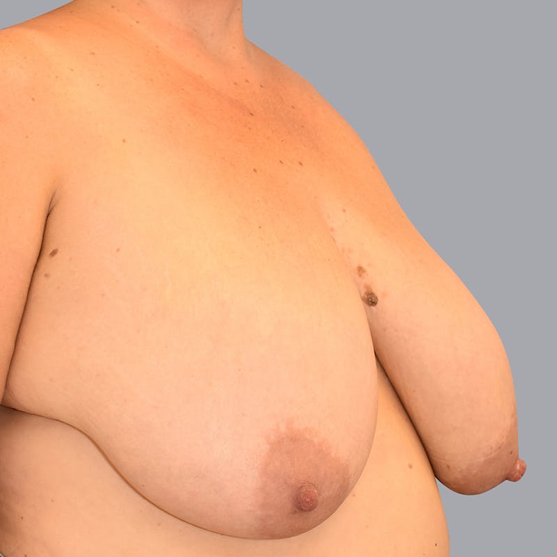 Breast Reduction Gallery - Patient 55333069 - Image 5