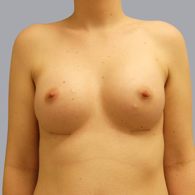 Breast Augmentation Before & After Gallery - Patient 55333113 - Image 2