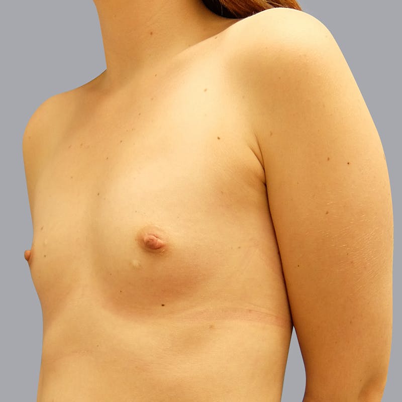 Breast Augmentation Gallery - Patient 55333113 - Image 5