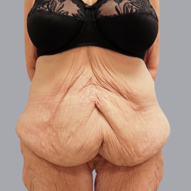 Abdominoplasty Before & After Gallery - Patient 48704198 - Image 1