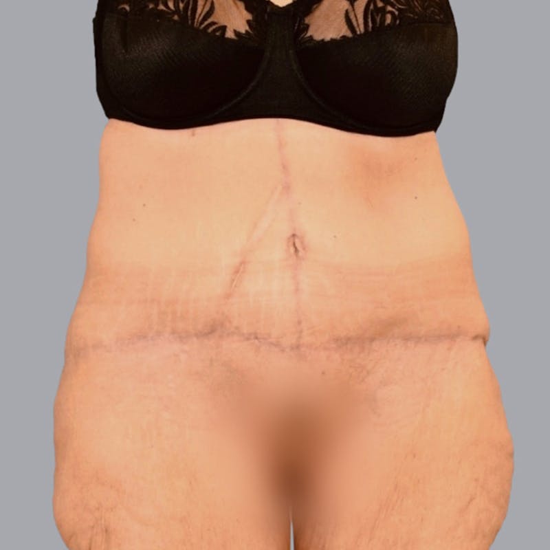 Abdominoplasty Before & After Gallery - Patient 48704198 - Image 2
