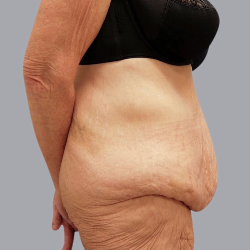 Abdominoplasty Before & After Gallery - Patient 48704198 - Image 3