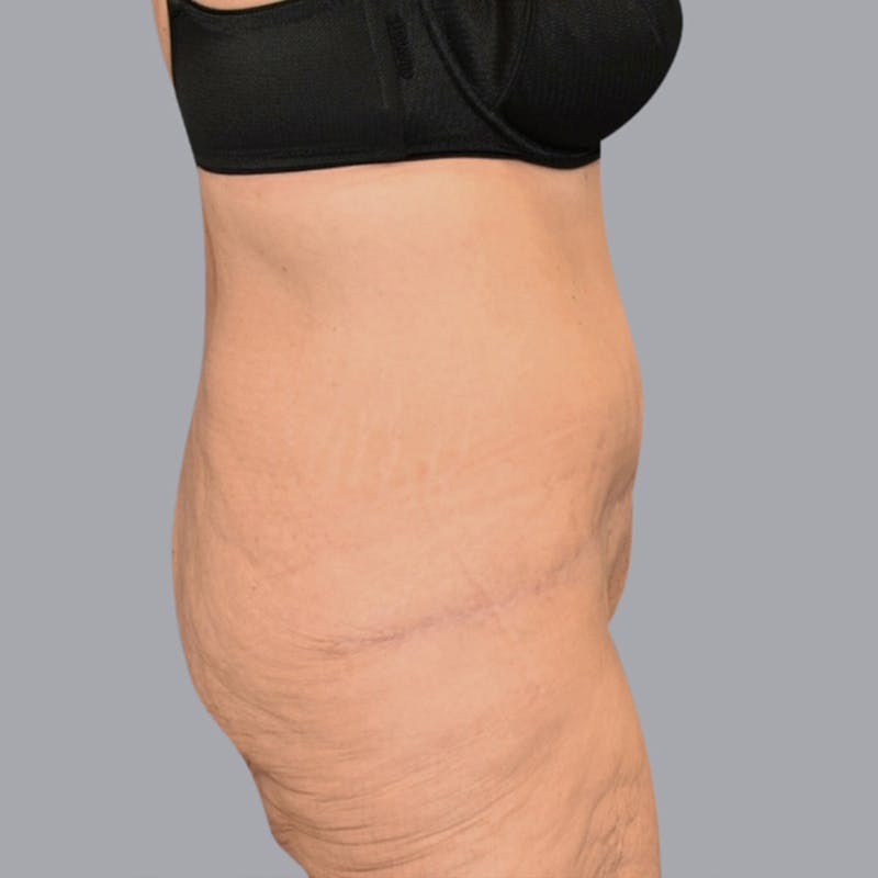 Abdominoplasty Before & After Gallery - Patient 48704198 - Image 4