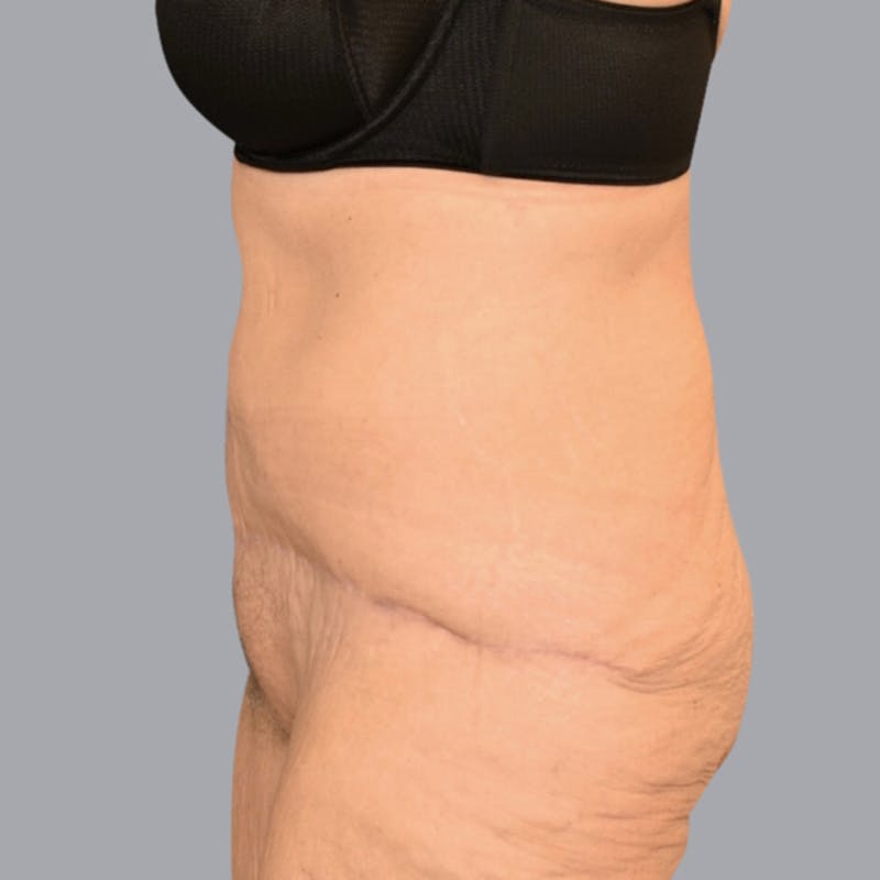 Abdominoplasty Before & After Gallery - Patient 48704198 - Image 5