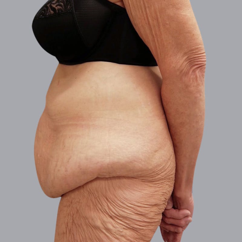 Abdominoplasty Before & After Gallery - Patient 48704198 - Image 5
