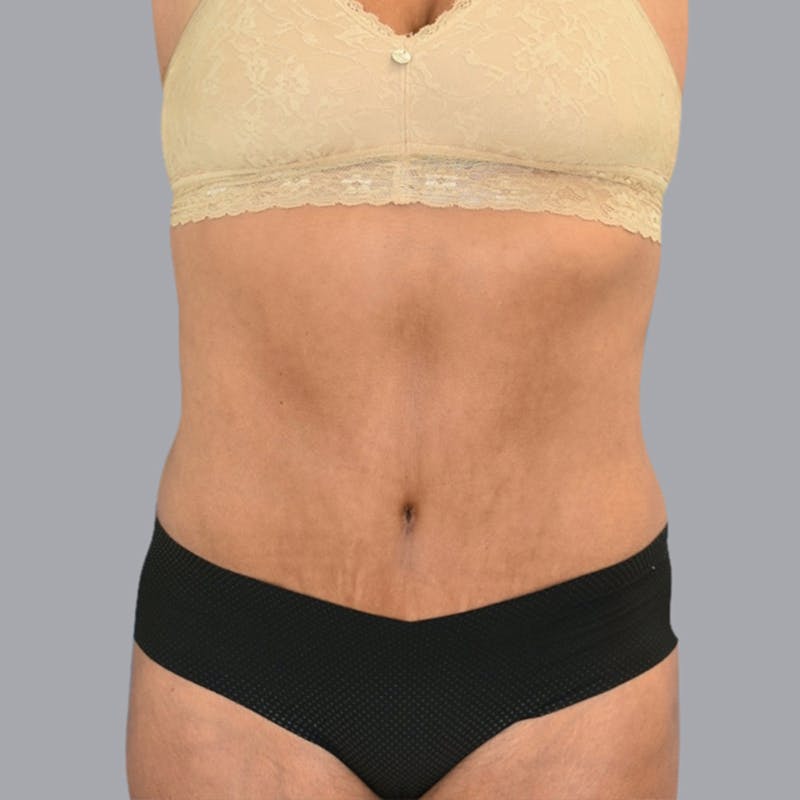 Abdominoplasty Before & After Gallery - Patient 48704249 - Image 2