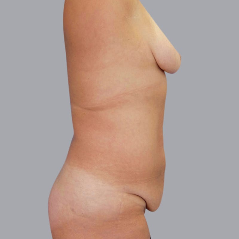 Abdominoplasty Before & After Gallery - Patient 48704249 - Image 3